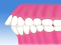 噛み合わせ症状のいろいろ