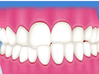 噛み合わせ症状のいろいろ