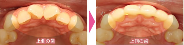 上前歯4本を裏側矯正した症例