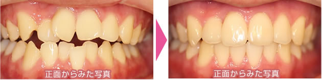 ガタガタ前歯の上下の裏側部分矯正
