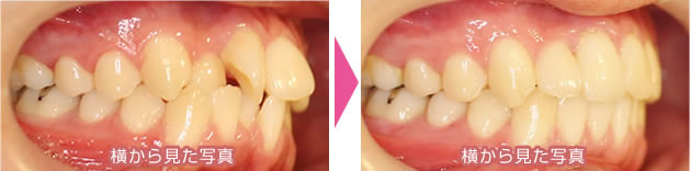 ガタガタ前歯の上下の裏側部分矯正