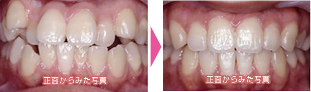 出っ歯・八重歯のコンビネーション矯正