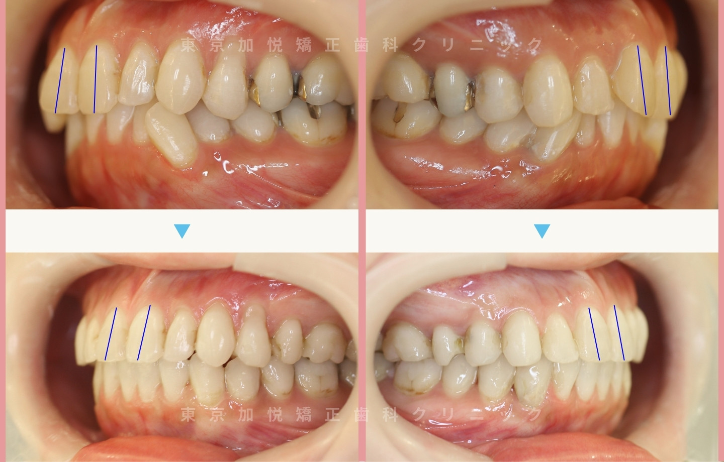抜歯をせずに歯科矯正の治療前後写真（全顎矯正）
