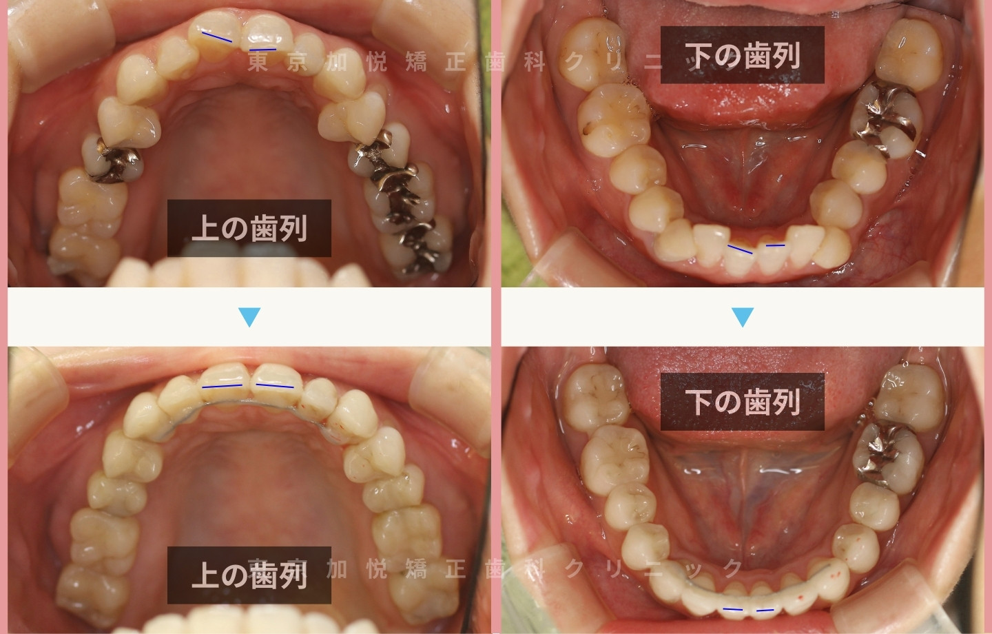 抜歯をせずに歯科矯正の治療前後写真（全顎矯正）