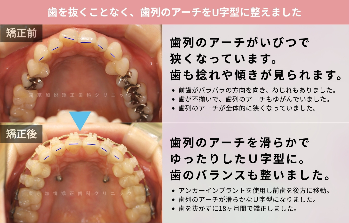 抜歯をせずに歯科矯正の治療前後写真（全顎矯正）