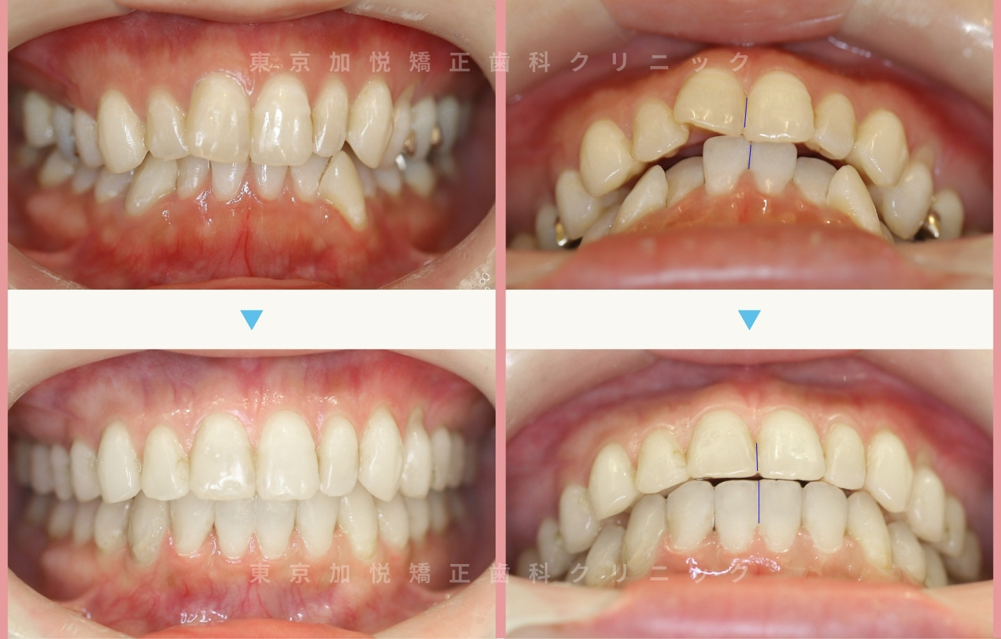 抜歯をせずに歯科矯正の治療前後写真（全顎矯正）