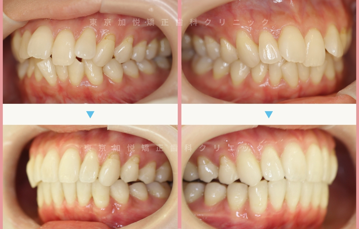 抜歯をせずに歯科矯正の治療前後写真（上下前歯のみ歯科矯正）