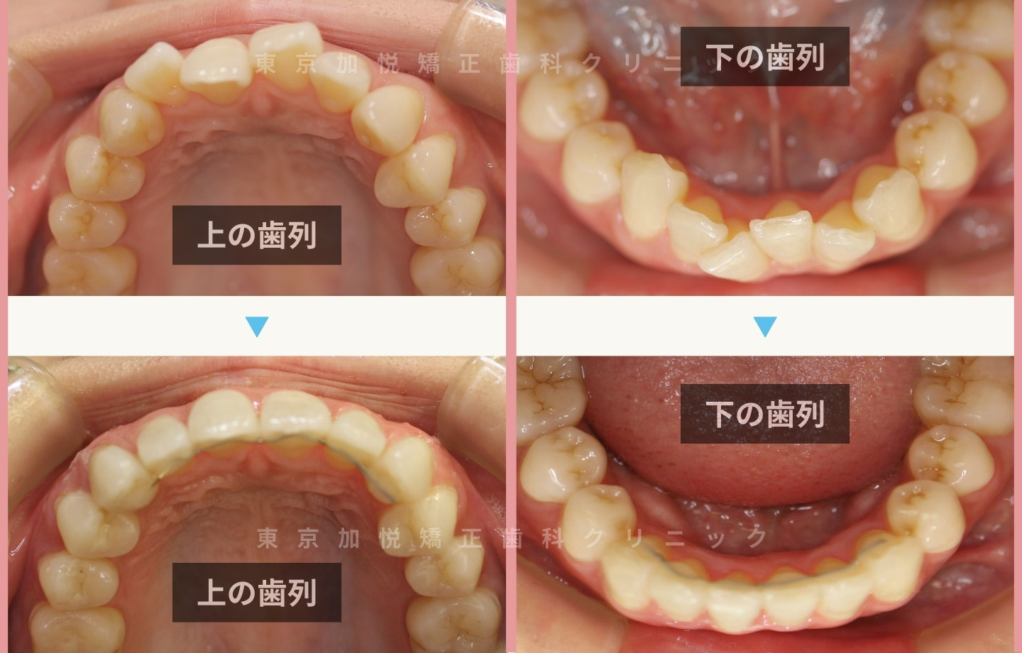 抜歯をせずに歯科矯正の治療前後写真（上下前歯のみ歯科矯正）