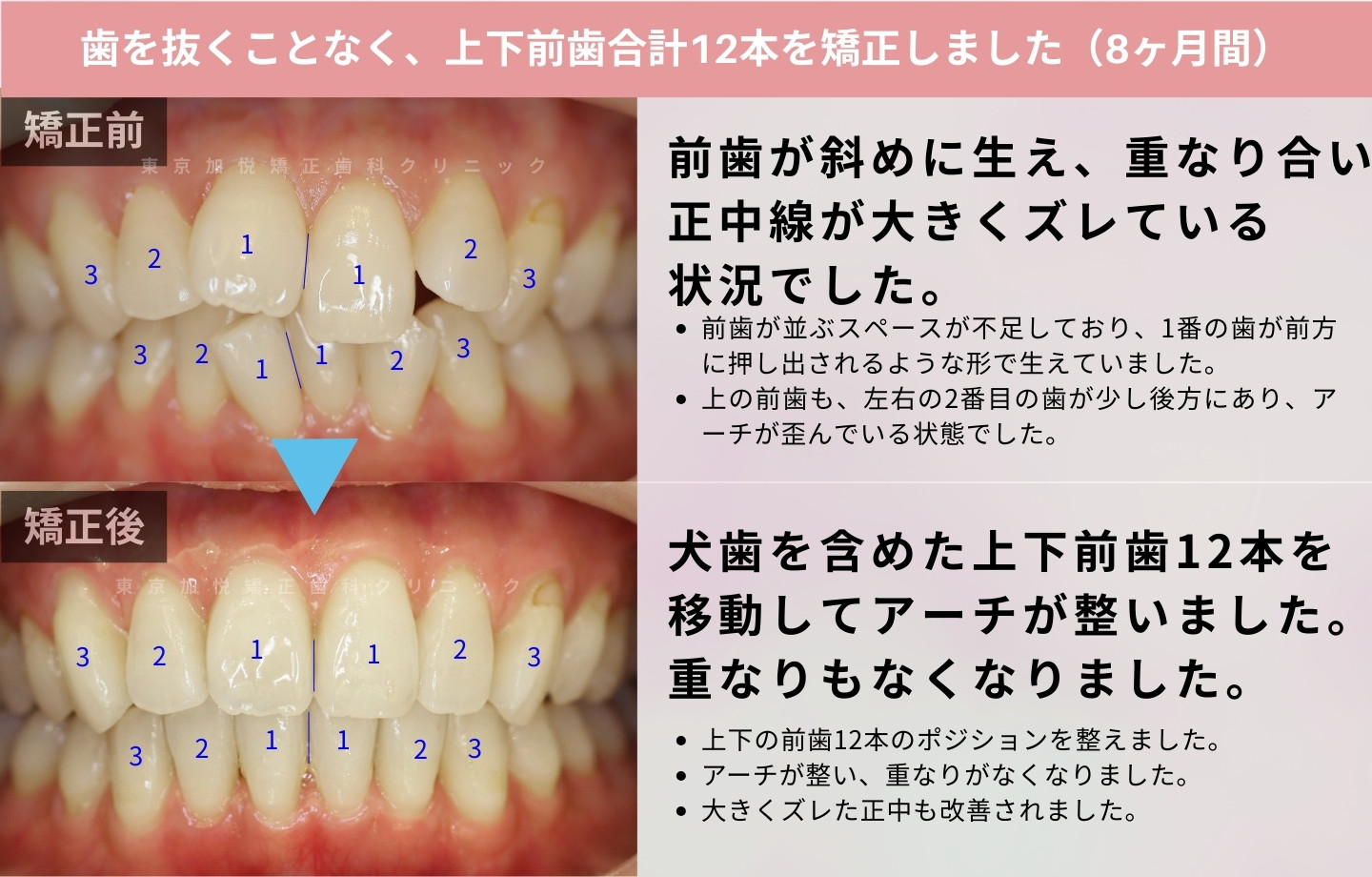 抜歯をせずに歯科矯正の治療前後写真（上下前歯のみ歯科矯正）