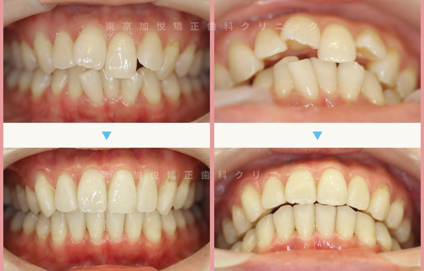 抜歯をせずに歯科矯正の治療前後写真（上下前歯のみ歯科矯正）