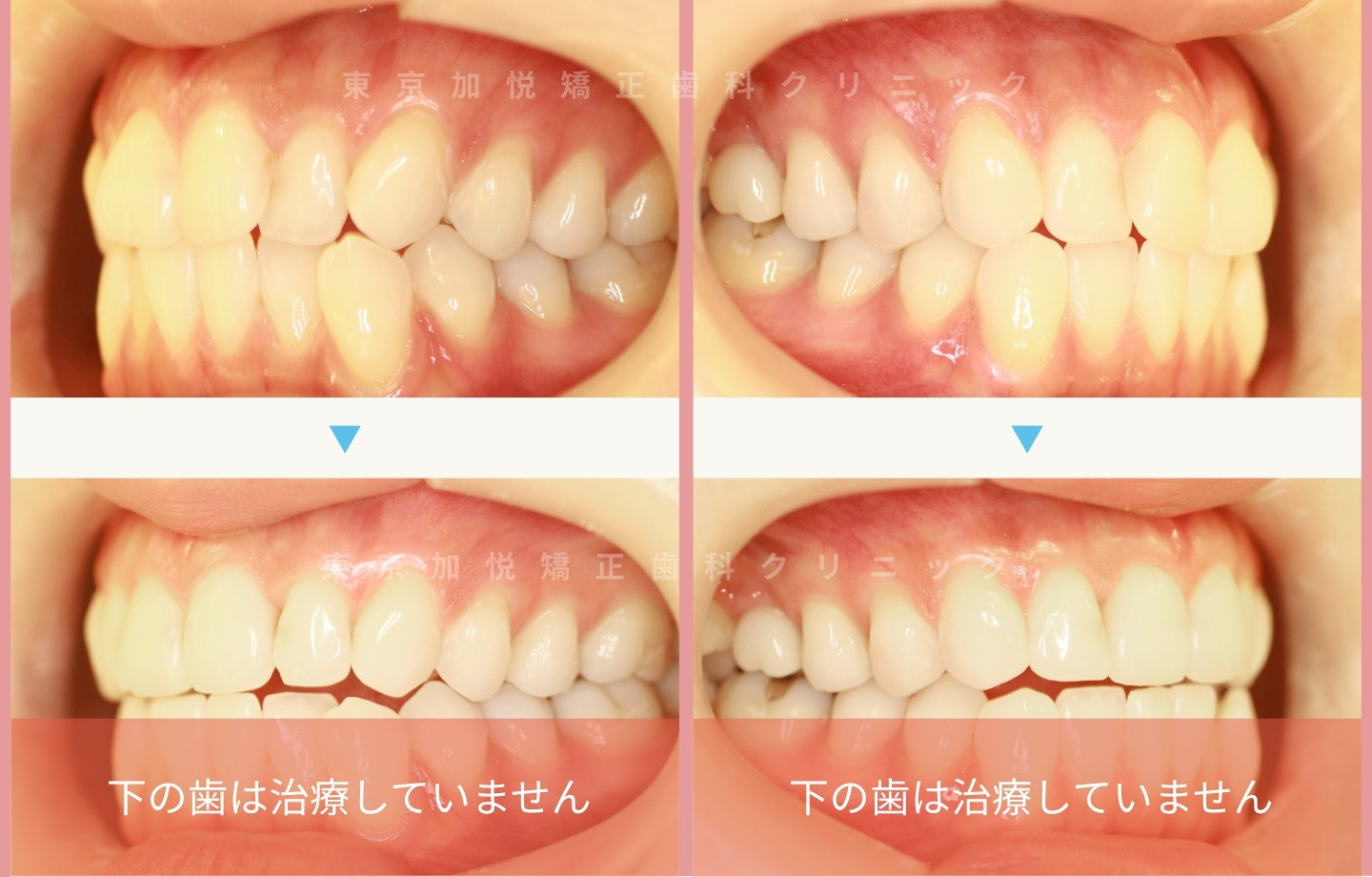 抜歯をせずに歯科矯正の治療前後写真（上前歯のみ歯科矯正）