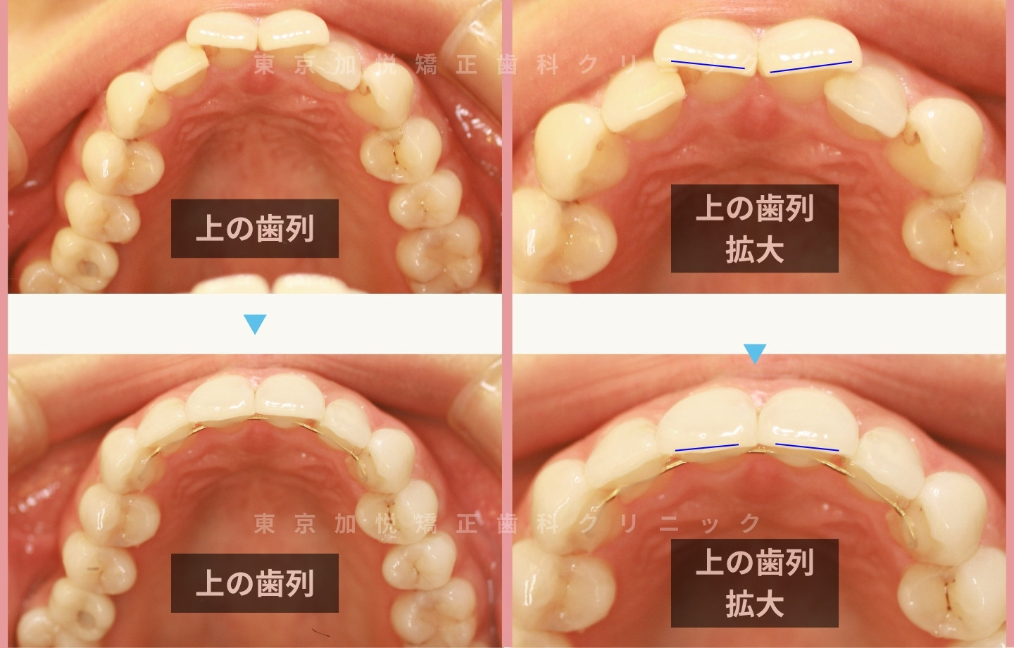 抜歯をせずに歯科矯正の治療前後写真（上前歯のみ歯科矯正）