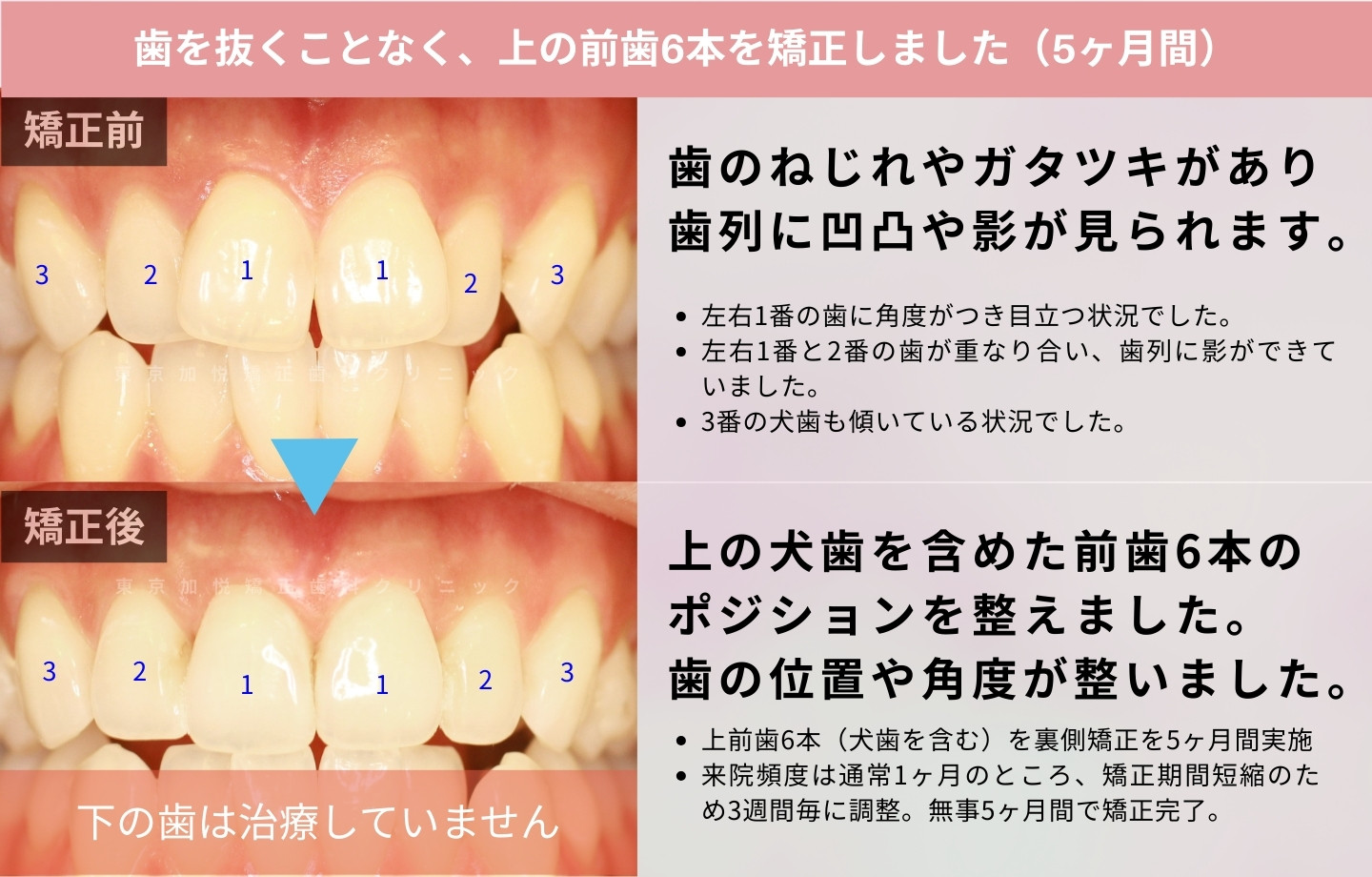 抜歯をせずに歯科矯正の治療前後写真（上前歯のみ歯科矯正）