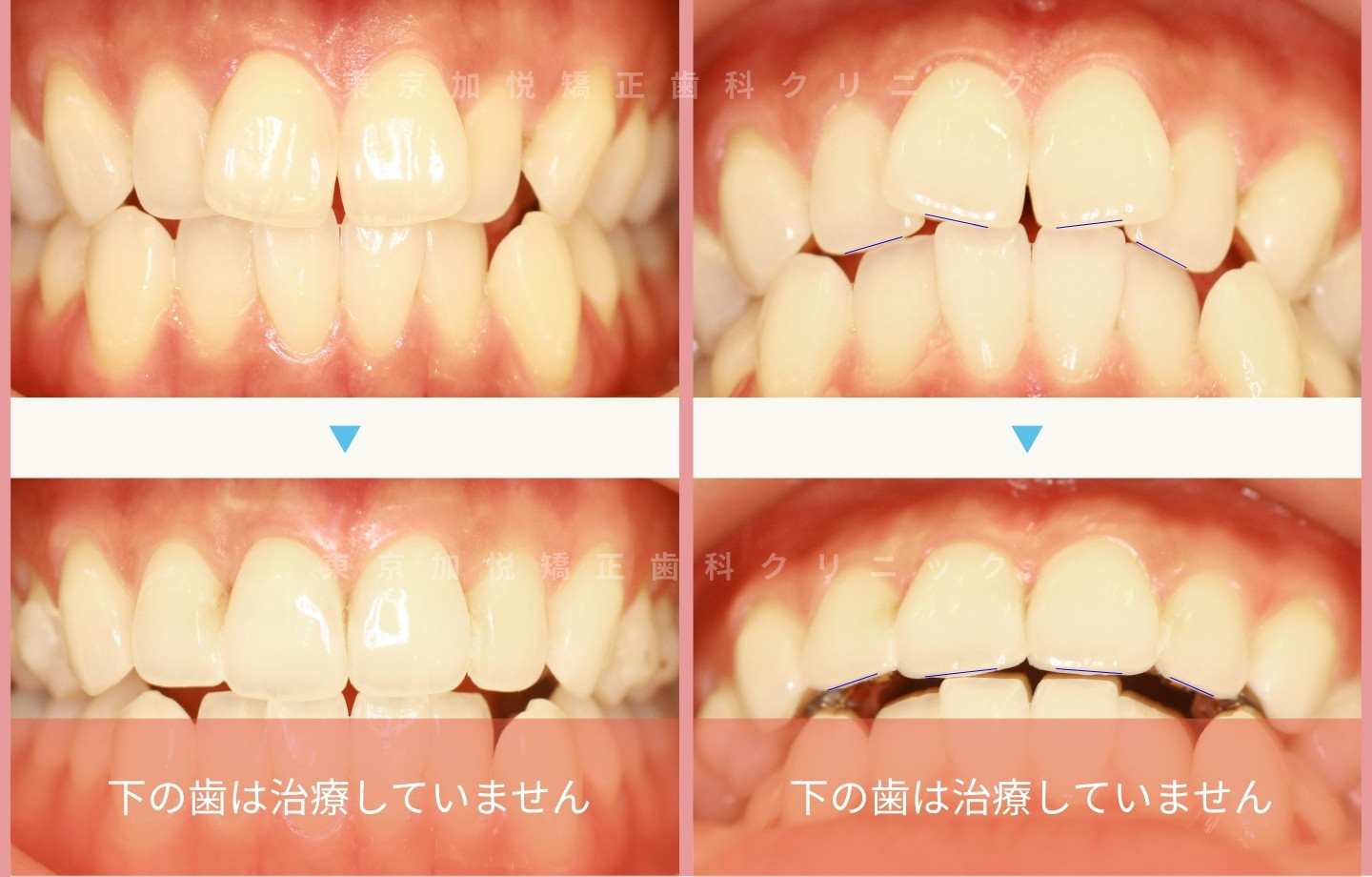 抜歯をせずに歯科矯正の治療前後写真（上前歯のみ歯科矯正）