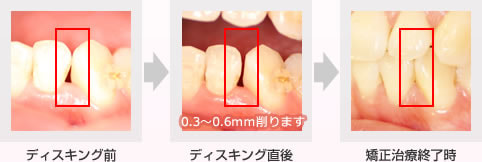 健康な歯を削るのって、身体に悪くないのでしょうか？