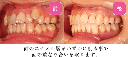 歯列を横方向・前方向に拡げ、全体のスペースを確保