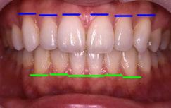 歯頚部（歯肉部）ライン