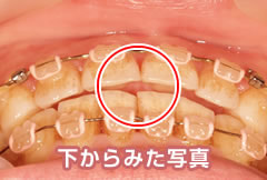 セカンドオピニオンで来院された方の症例（矯正治療２年経過）