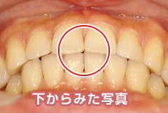 噛み合わせ治療終了後