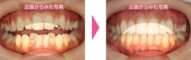3か月間で下前歯の叢生をスピード矯正