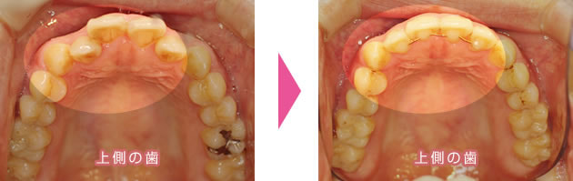 上前歯の裏側・部分矯正で叢生・クロスバイトを改善